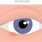 eye stye