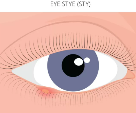 eye stye