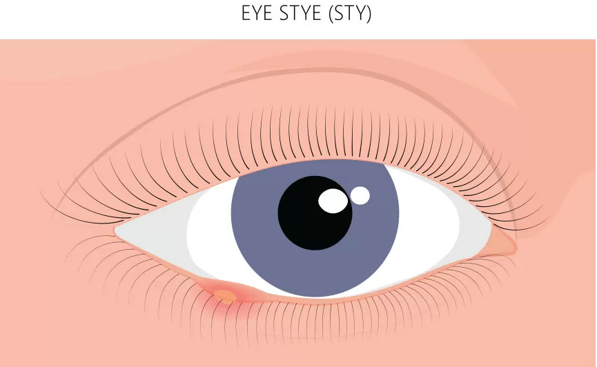 eye stye