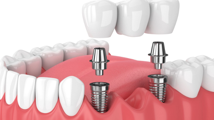 Dental Implants